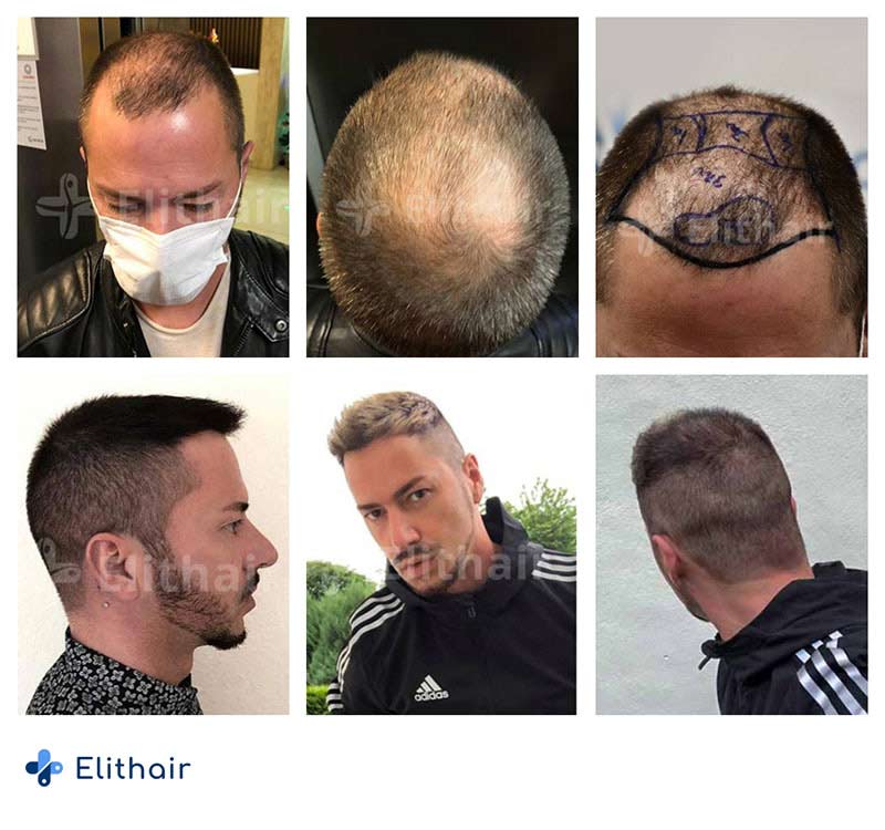 DHI Haartransplantation Alle Infos Zur DHI Methode Elithair