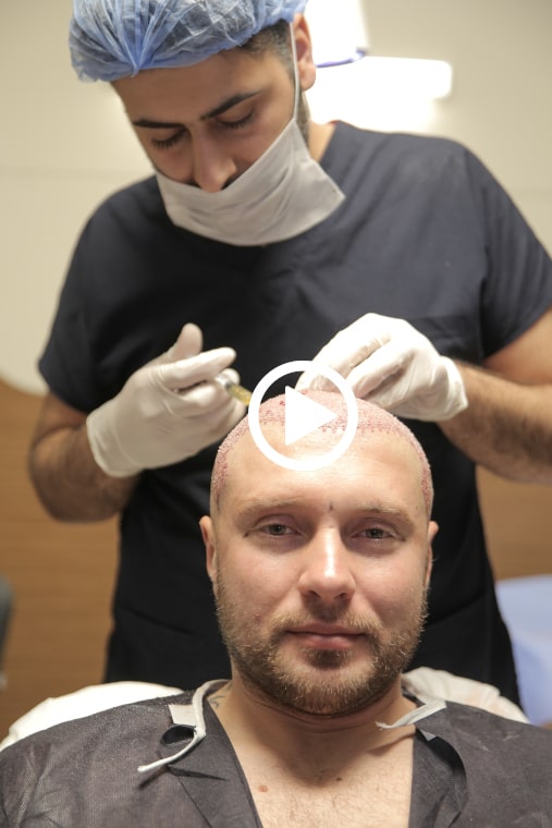 PRP Behandlung nach Haartransplantation Elithairtransplant