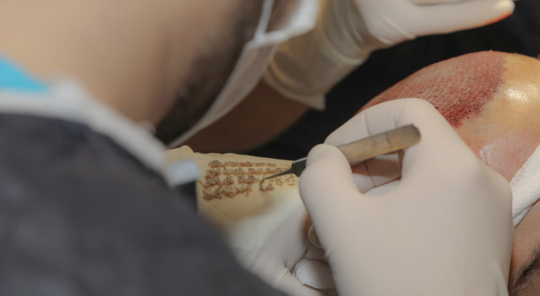 The hair transplant procedure in Turkey during Corona continues to be safe and is performed professionally