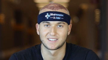 Patient nach seiner Haartransplantation Erfahrung in der Türkei