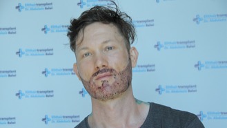 Christopher J in einem Video nach seiner Haartransplantation Erfahrung in der Türkei