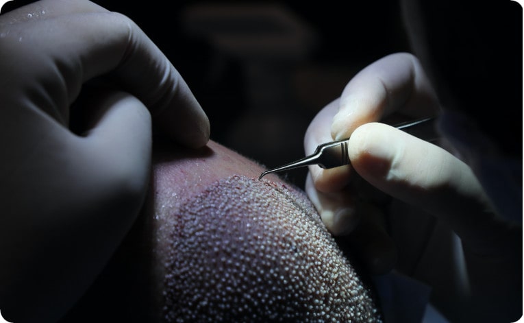 Une greffe de cheveux FUE est moins invasive que la méthode FUT