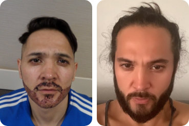 Male patient with own hair transplantation on the beard before and afterwards