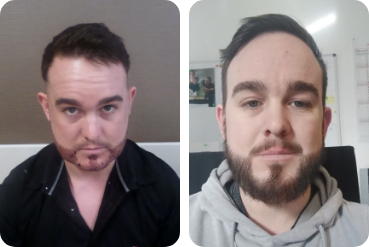 Patient hair transplant on beard before and after