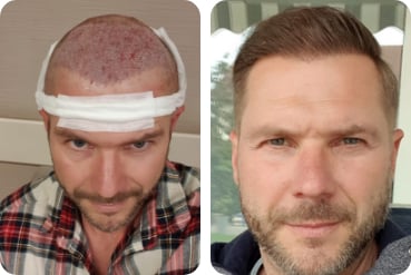 Haartransplantation Vorher Nachher Unsere Ergebnisse Auf Einem Blick