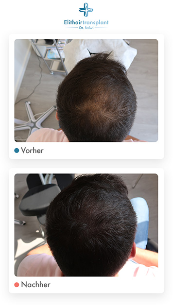 Haarpigmentierung Erfahrungen