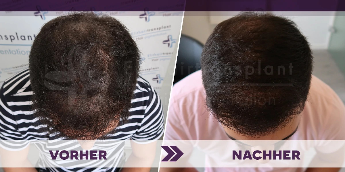 Haarpigmentierung: Vorher Nachher Galerie - Haarpigmentierung