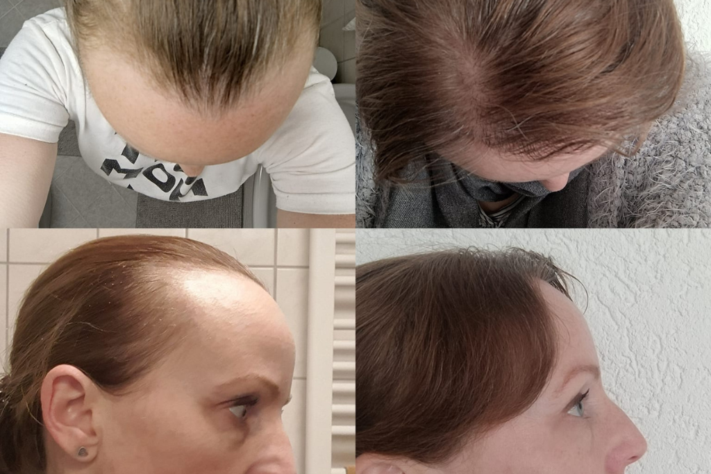 La perte de cheveux chez les femmes peut venir de plusieurs facteurs tels que l'alopécie androgénétique