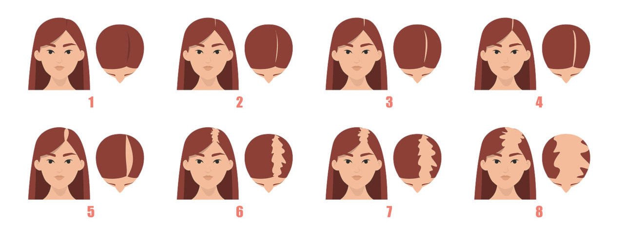 les étapes de la perte de cheveux chez la femme diffère de celle des hommes