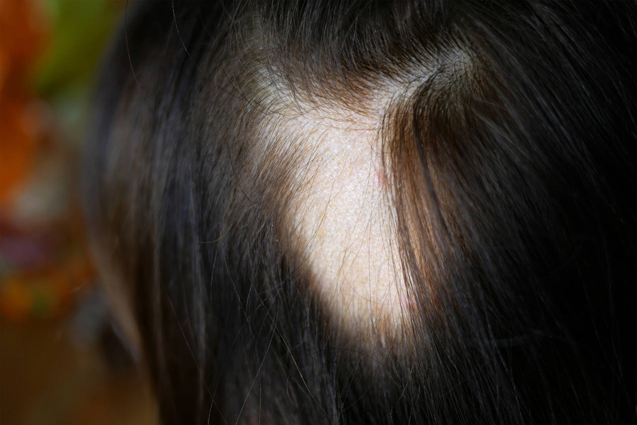 une alopécie araeta est aussi connue sous le nom de perte de cheveux circulaire