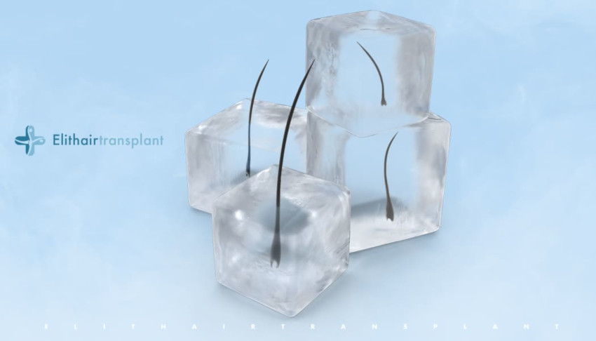 greffe de cheveux avec ice graft
