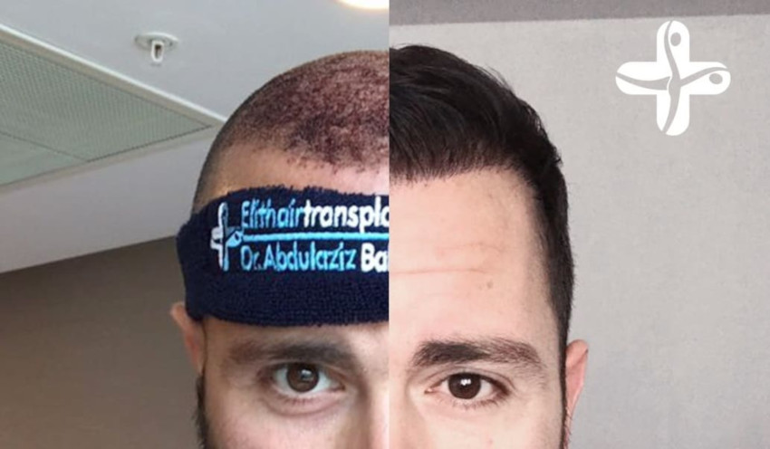 augmenter la densité des cheveux grâce à l'implant capillaire