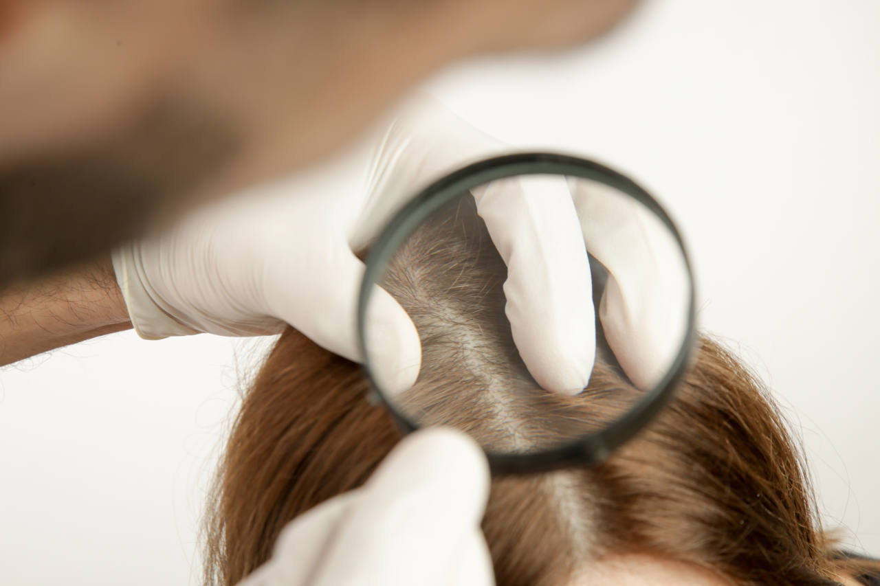 Une fois réglée la question de comment savoir si on perd ses cheveux, il faut consulter un dermatologue