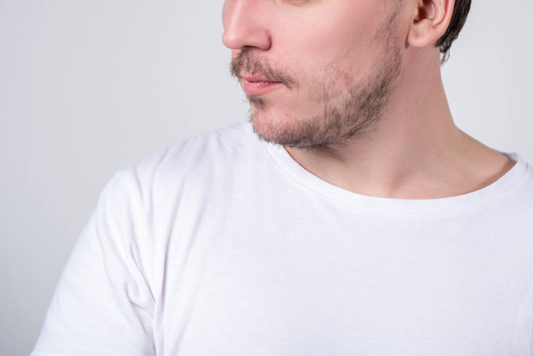photo de profil du buste et du bas du visage d’un homme à la barbe clairsemée souhaitant effectuer un implant de barbe