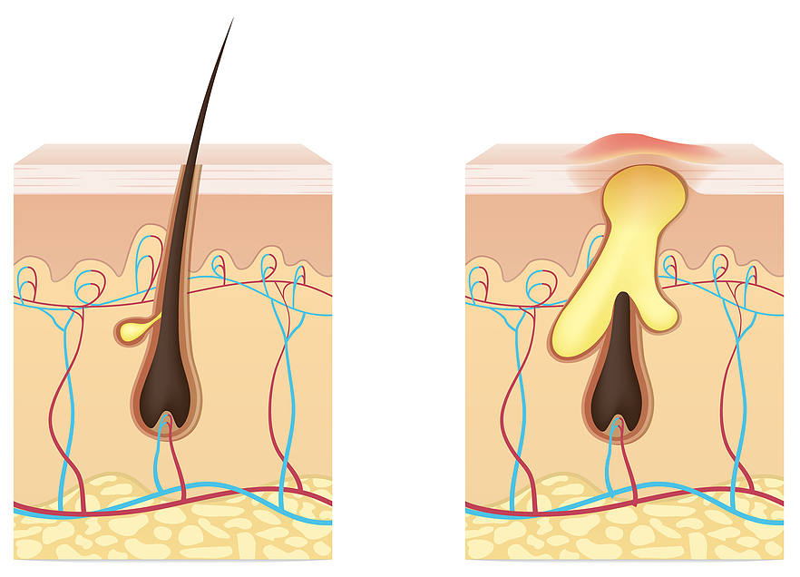 l'exces de sébum peut boucher les pores de vos cheveux et provoquer une pelade