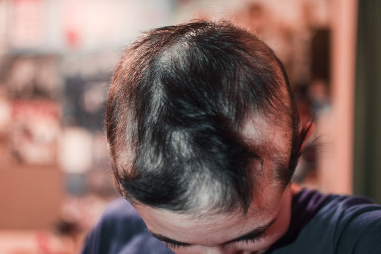 dessus du cuir chevelu d’une personne atteinte d’alopecia areata