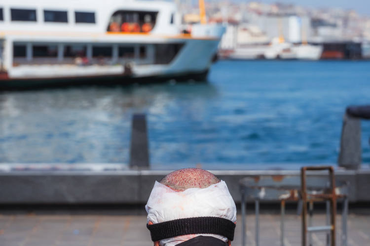La tête d'un homme après une greffe de cheveux, assis en extérieur dans la rue en Turquie.
