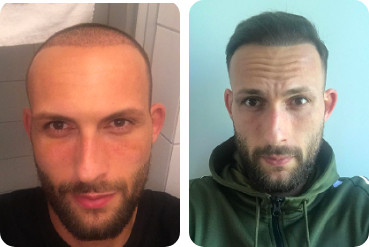 Comparaison avant / après : patient brun ayant subi une greffe cheveux avec 3 000 greffons