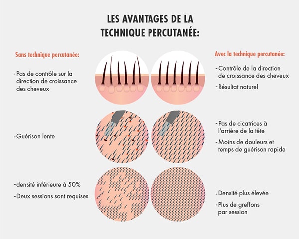 Illustration montrant les différences entre la greffe de cheveux avec et sans technique percutanée