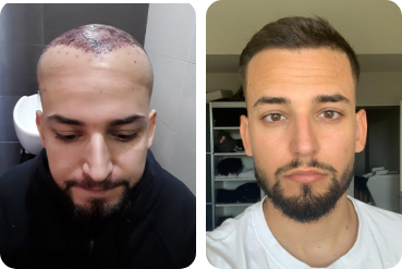 Greffe de cheveux chez un jeune homme pour épaissir les cheveux, avant et après