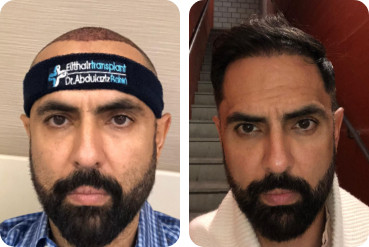 Greffe de cheveux sur la ligne frontale d’un homme avant et après