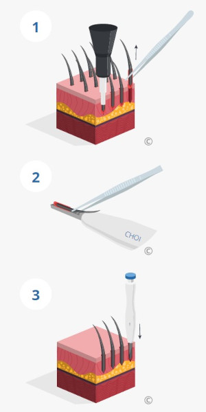 Illustration de la procédure d’implantation des greffons selon la méthode DHI