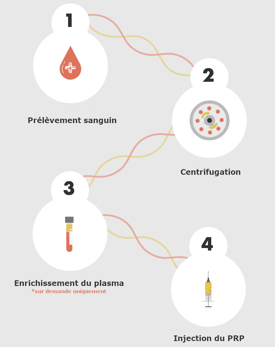 Infographie expliquant le processus d'extraction du plasma riche en plaquettes pour le traitement des greffes de cheveux par PRP