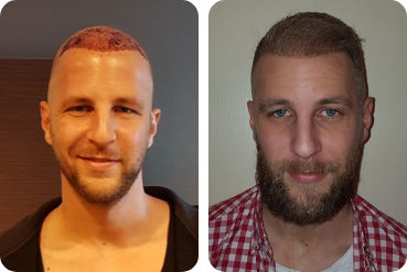 Patient Elithair avant et après sa greffe de cheveux de 3 500 greffons sur un haut front