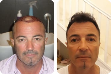Patient d'âge moyen avant et après une greffe de cheveux pour augmenter la densité capillaire