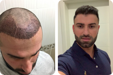 Patient masculin avant et après sa greffe de cheveux pour un front haut