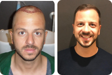 Portaits d’un jeune homme avant sa greffe de cheveux et après avec les cheveux épaissis