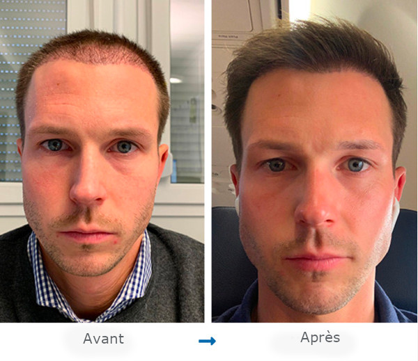 Portrait de face d’un patient Elithair avant et après sa greffe de cheveux pour un front haut