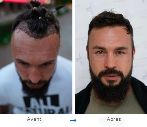 Portraits d’un patient Elithair avant et après une greffe de cheveux pour la correction de sa ligne frontale