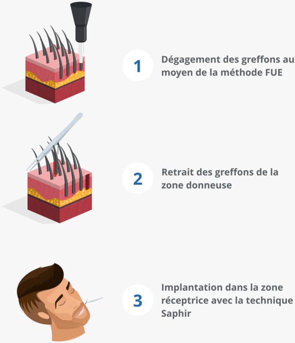 Procédure d'une transplantation de barbe