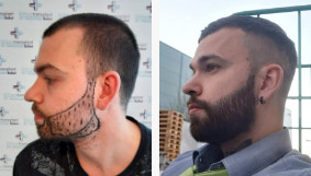 Résultat de la transplantation de poils de barbe