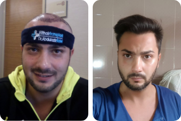 Un patient avant et après son traitement des cheveux chez Elithair