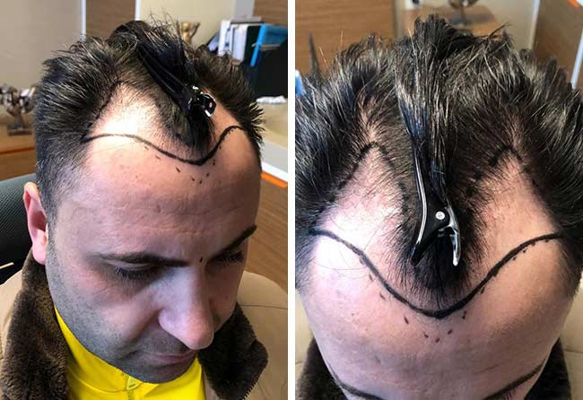 Image avant greffe de cheveux saphir 4200 greffons Murat Kizilkaya