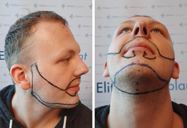 Image avant implant de barbe fue saphir 3250 greffons Sascha Lockermann