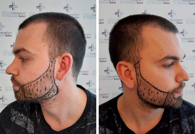 Image avant implant de barbe saphir 4250 greffons Nico Müller