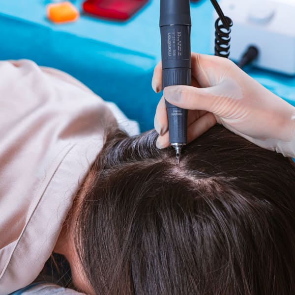 memebre de l'équipe médicale Elithair extrayant les greffons d'un patient avec la méthode fue