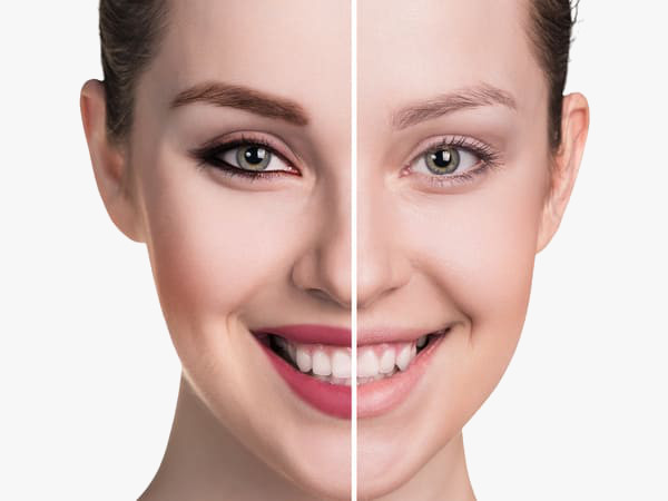 vue d'une greffe de sourcil avant et après