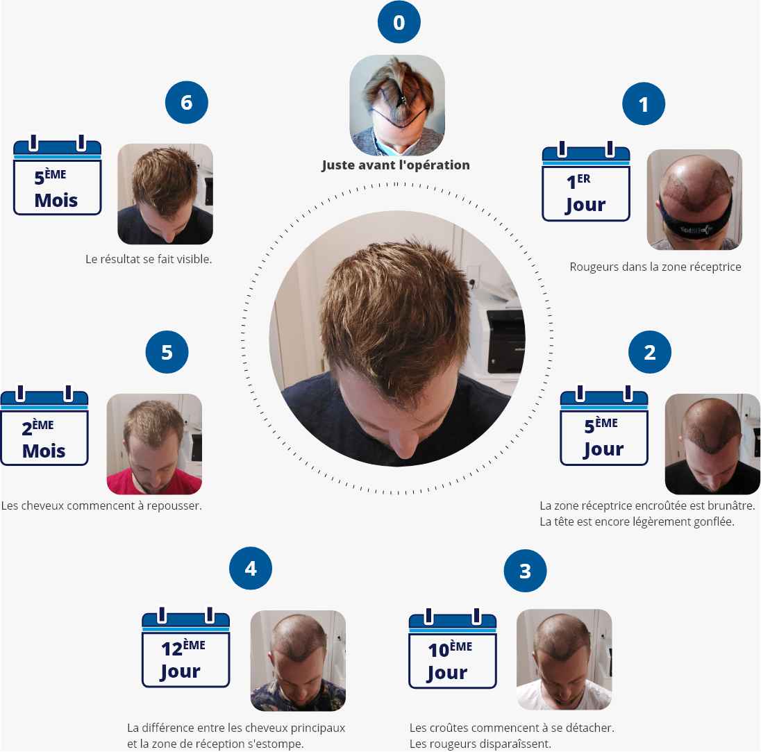 Infographie avec photos montrant les étapes du processus de guérison après une greffe de cheveux du premier jour au cinquième mois