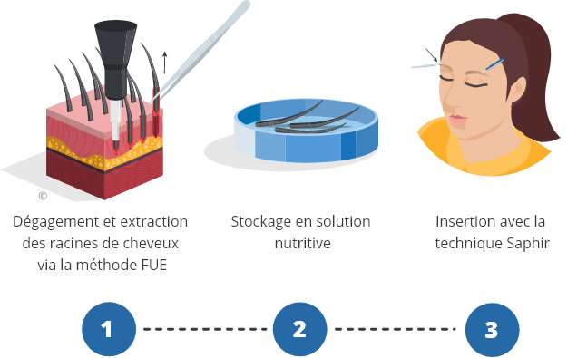 infographique montrant le processus d'une greffe de sourcils