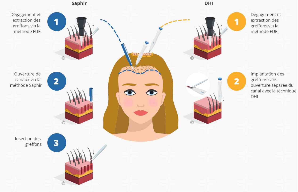 infographique montrant le processus d'une greffe de cheveux sdhi