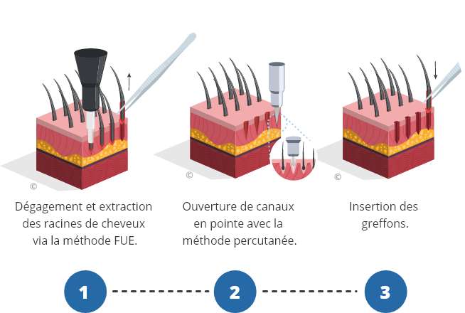 infographique montrant le processus d'une greffe de cheveux percutanée