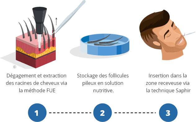 infographique montrant le processus d'une greffe de barbe