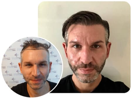 patient elithair s'étant fait greffer 4250 greffons