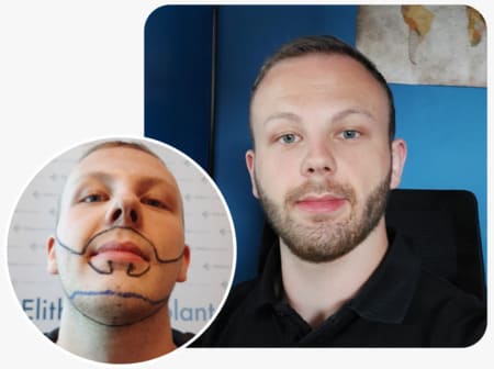 patient elithair ayant une greffe de barbe avec 3250 greffons