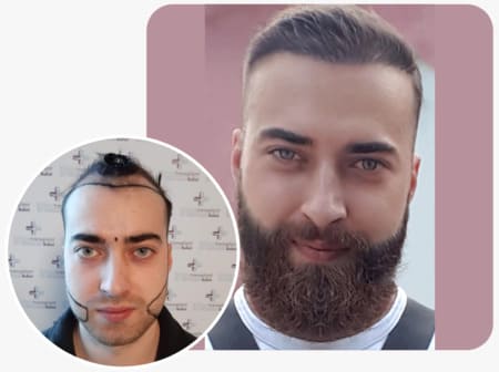 patient elithair ayant une greffe de barbe avec 4250 greffons