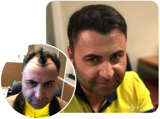 patient elithair s'étant fait greffer 4200 greffons avec la greffe de cheveux percutanée